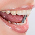Zahnheilkunde | Implantologie